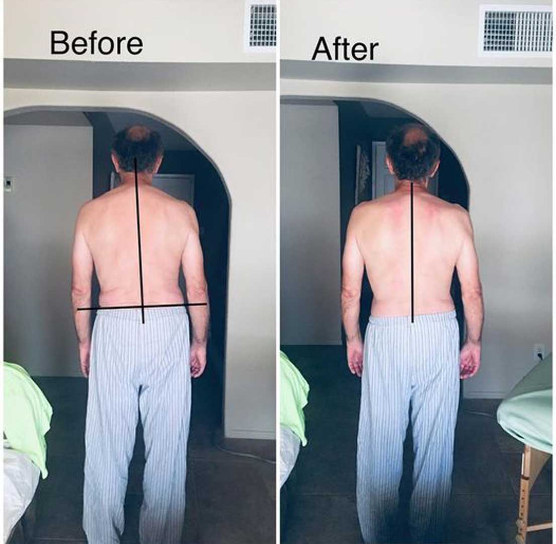 Posture of a man, before and after therapy